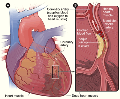 Artery Blockage Heart Attack